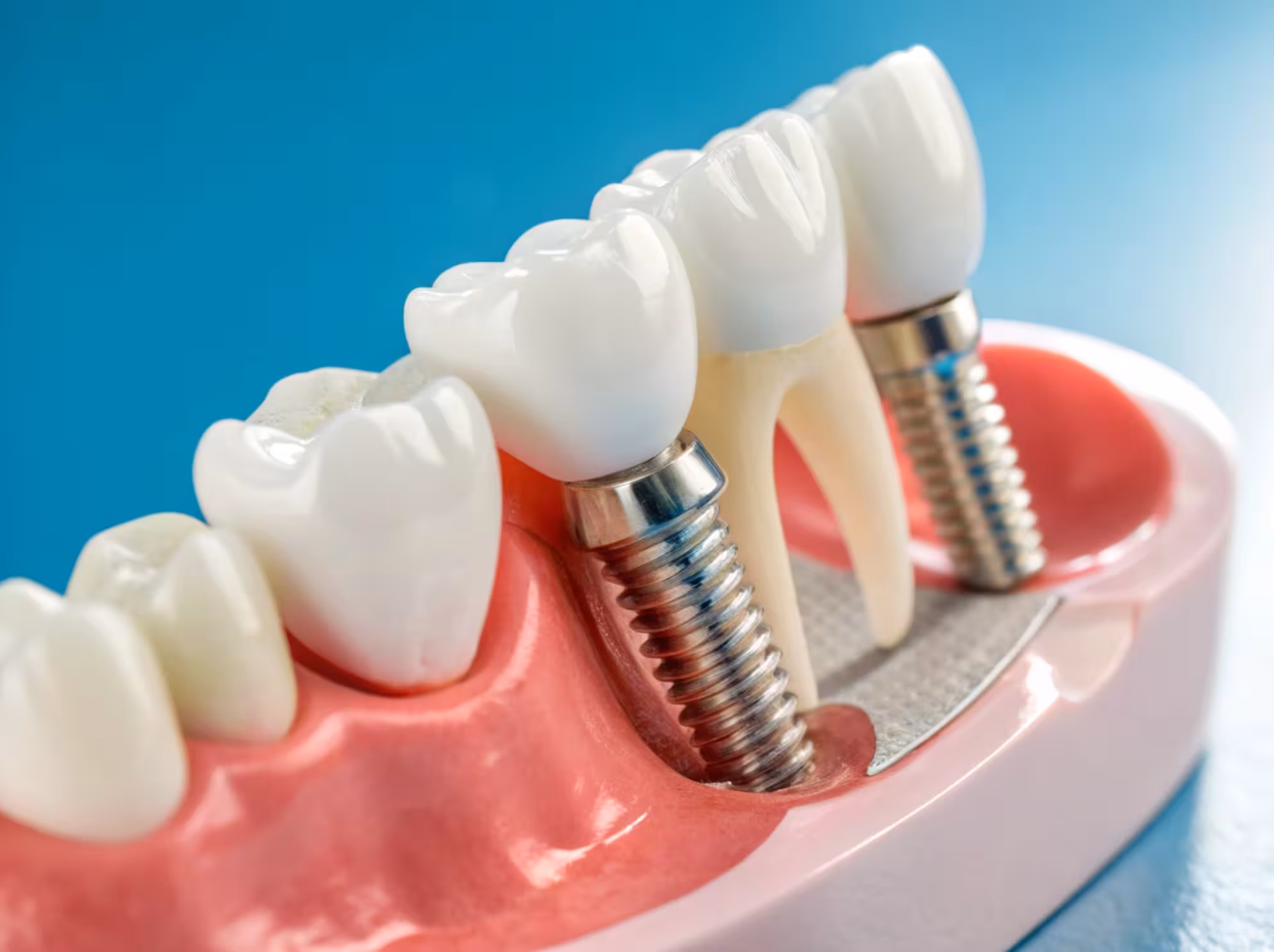Implant Restorations